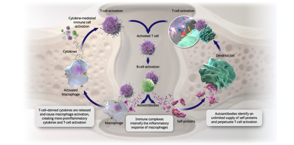 Graphic depicting the role of autoantibodies and cytokines in the process of RA pathogenesis
        